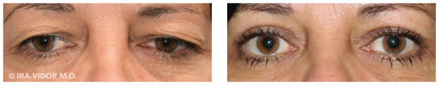 Does Insurance Cover Blepharoplasty or other Eyelid Surgery?